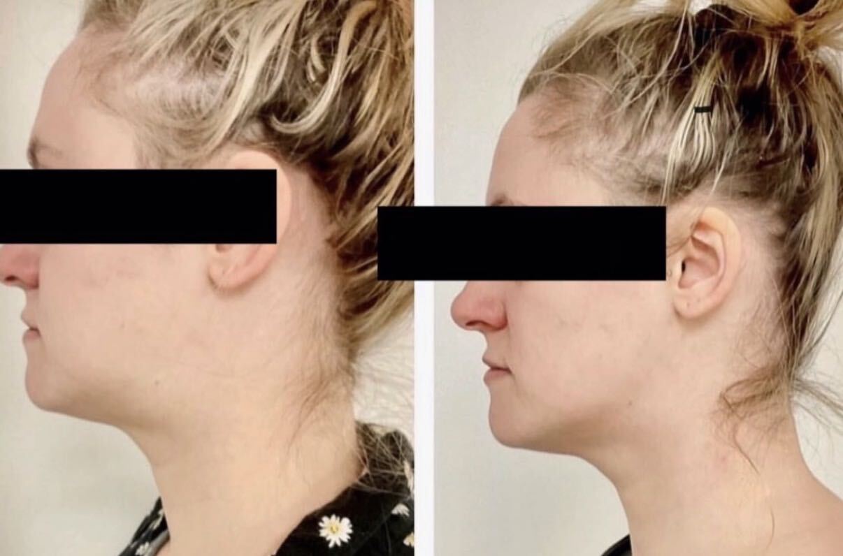 Before and after, side profile of a client's chin and jawline