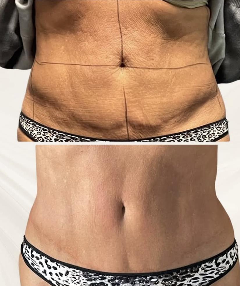 Before and after, front view of loose skin on a client's stomach. Before on top, after below.